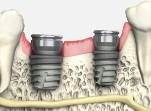 implant-ngan-1