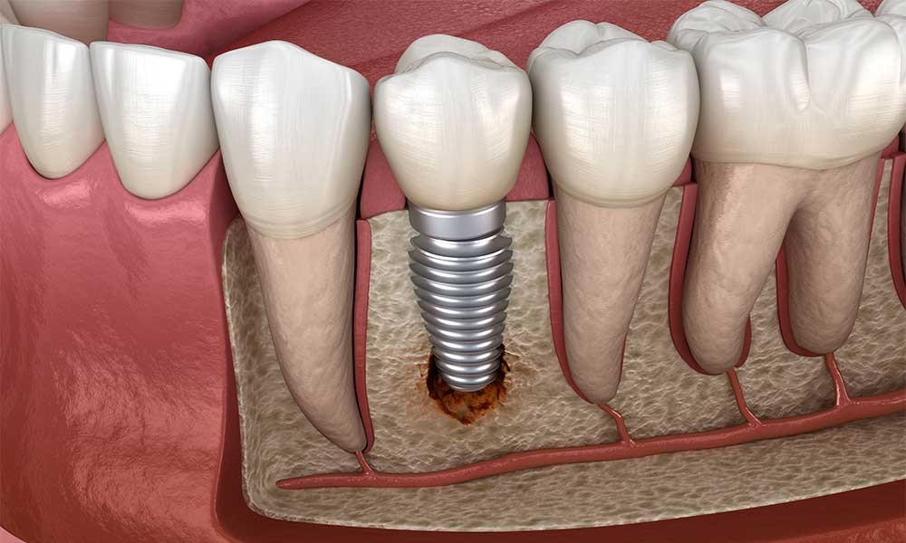 thao-implant