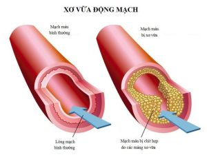 Tổn thương xơ vữa của động mạch chủ