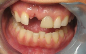 ảnh minh họa: Răng bị chấn thương