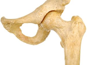 Kỹ thuật thay khớp háng mới giúp bệnh nhân có thể phục hồi nhanh chóng