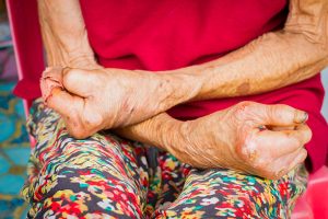 Bệnh phong có lây không là câu hỏi của nhiều người