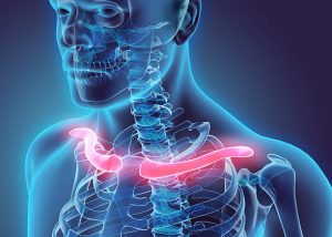 Sơ cứu gãy xương đòn đúng cách giúp hạn chế các biến chứng