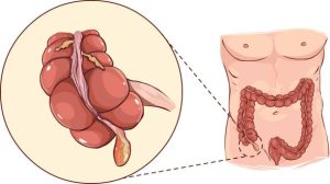 hướng dẫn chẩn đoán và điều trị viêm ruột thừa