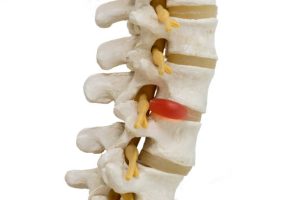 Hình ảnh minh họa thoát vị đĩa đệm