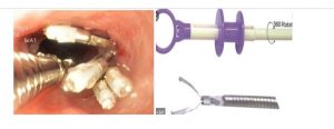 Hình ảnh Clip OTSCNguồn ảnh: Vinmec.com