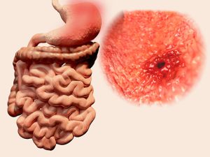 OTSC: Công nghệ tiên tiến giúp điều trị loét dạ dày hiệu quả
